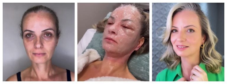 Peeling de fenol moradora de Maringá viraliza após fazer procedimento