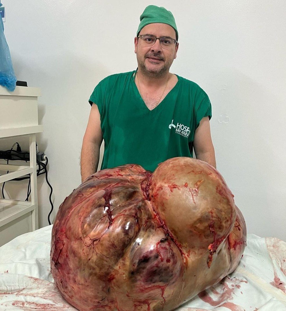 Tumor com cerca de 46 kg é retirado de paciente em Itaperuna, no RJ — Foto: Divulgação/Glacio Boecheat