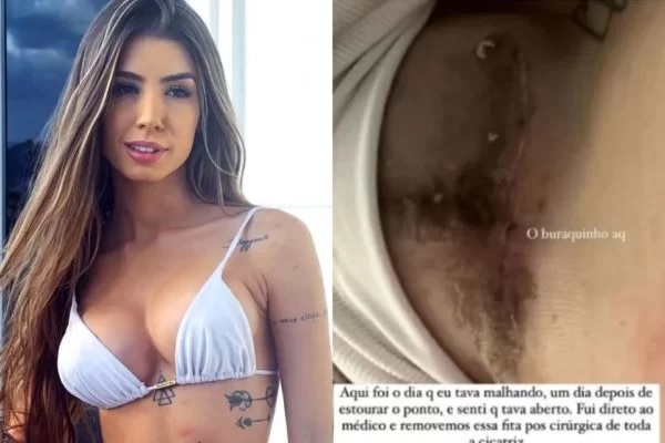 A influenciadora digital Maria Lina usou as redes sociais para revelar que teve problemas com a cirurgia para colocar prótese nos seios.