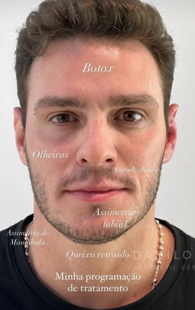 Harmonização facial masculina: veja como a técnica funciona!