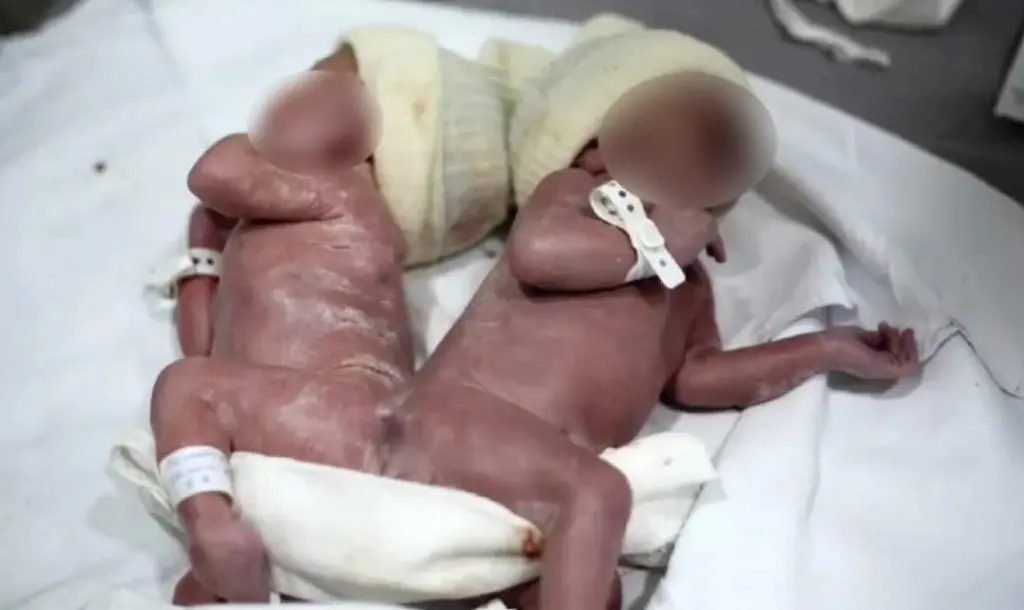 Gêmeos siameses nascem em hospital do Paraná
