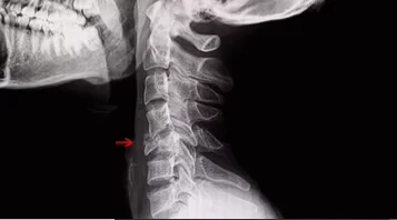 Estalar o pescoço é perigoso? Entenda.