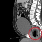 homem-passa-por-cirurgia-apos-colocar-coco-nas-partes-intimas-ed217394-9a29-4708-aa2f-23e99dfd3d50-880×557-1