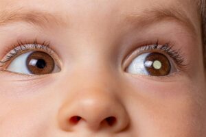 retinoblastoma-câncer-ocular