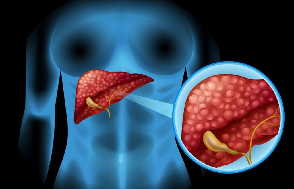 Sclerosis diagram in detail