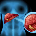 Sclerosis diagram in detail