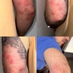 vítimas de percevejos