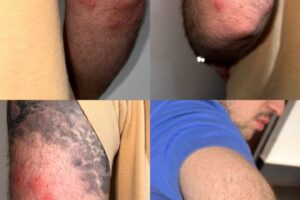 vítimas de percevejos